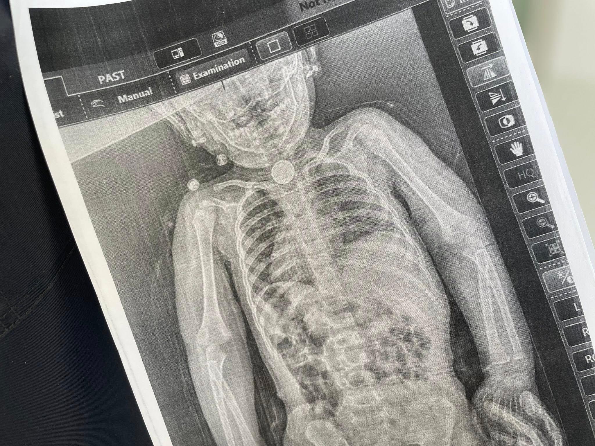 Львівські хірурги врятували дитину, яка три місяці прожила з батарейкою у стравоході