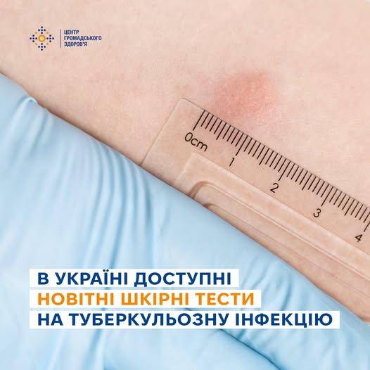 В Україні впроваджують нові шкірні тести для виявлення туберкульозної інфекції