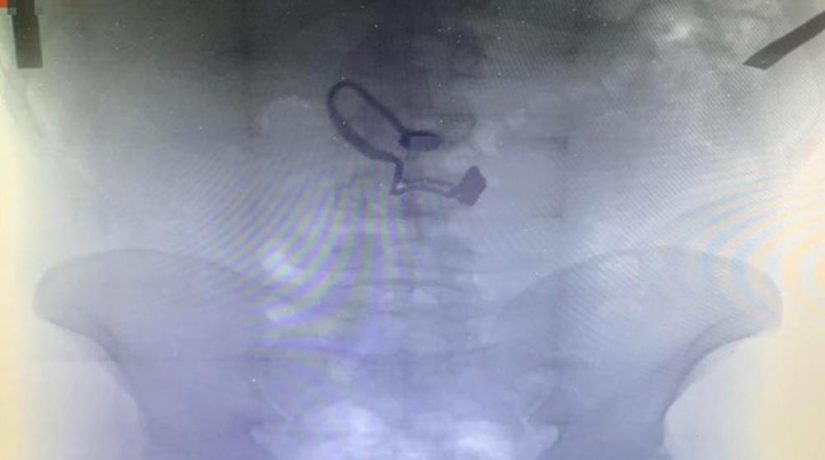 Полиция показала рентген злоумышленника, проглотившего украденную цепочку
