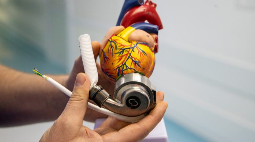 В киевской больнице впервые имплантировали механическое сердце стоимостью 4,5 млн грн