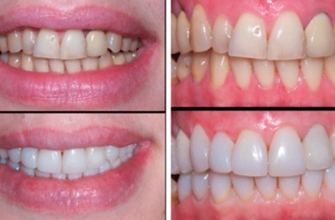 7 секретів зубних вінірів