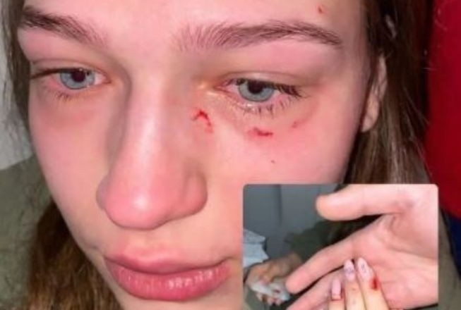 Відгризла ніготь та подряпала обличчя: у літаку в Домінікану побили дівчину (ФОТО)