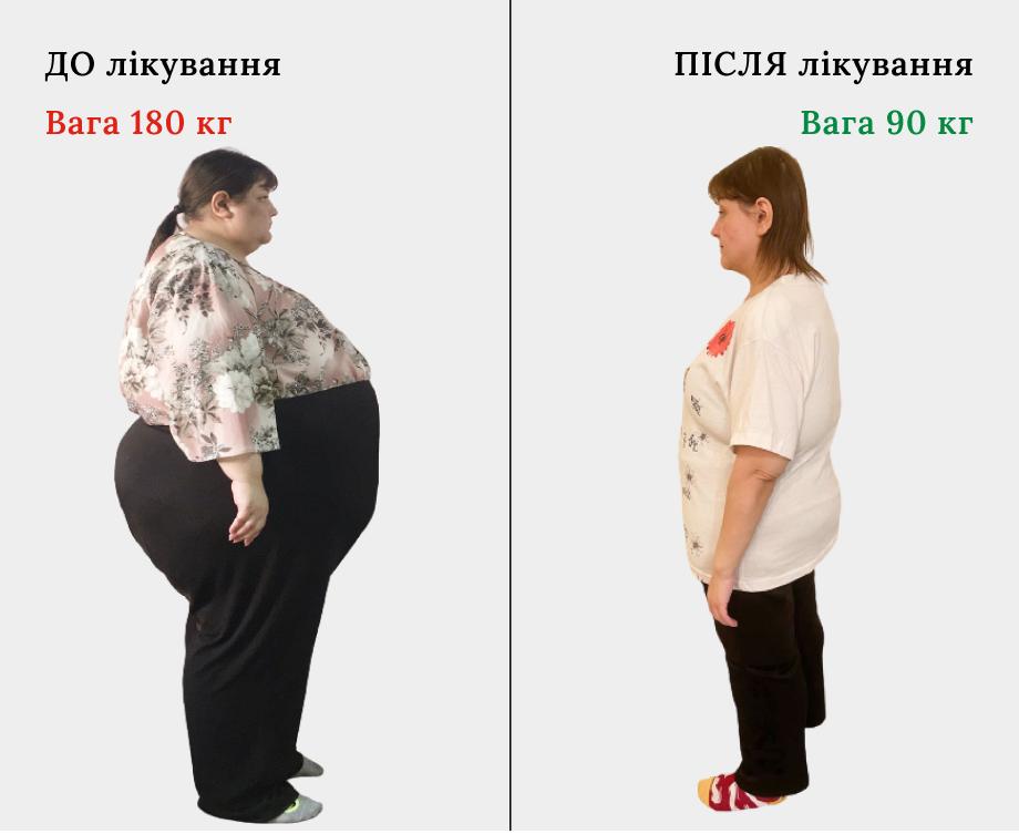 Коли вага стає гірше смерті: в Інституті Шалімова рятують від ожиріння ...