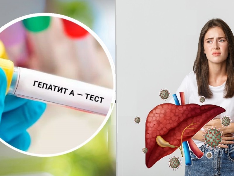 Гепатит А уже на Київщині – як від нього вберегтися