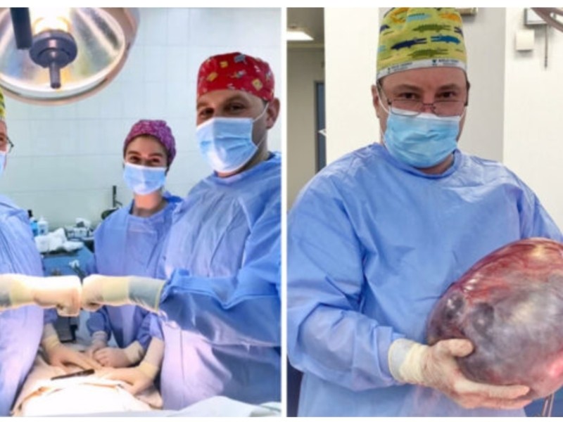 Просто виріс живіт: хірурги видалили жінці велетенську пухлину яєчника